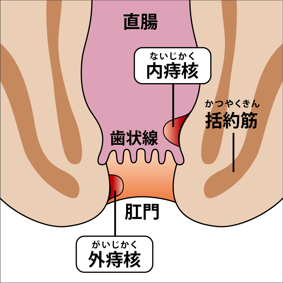 いぼ痔 ぢ 内痔核 外痔核 内視鏡検査なら足立外科胃腸内科医院 足立区青井 五反野の 外科 胃腸内科 内科 皮膚科