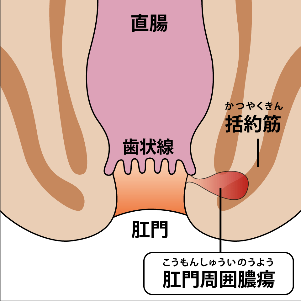 肛門周囲膿瘍