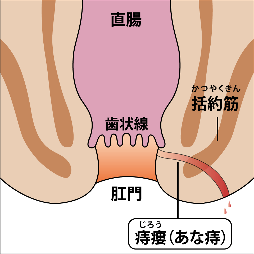 痔瘻（あな痔）